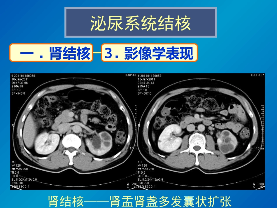 泌尿系统感染影像诊断_第14页