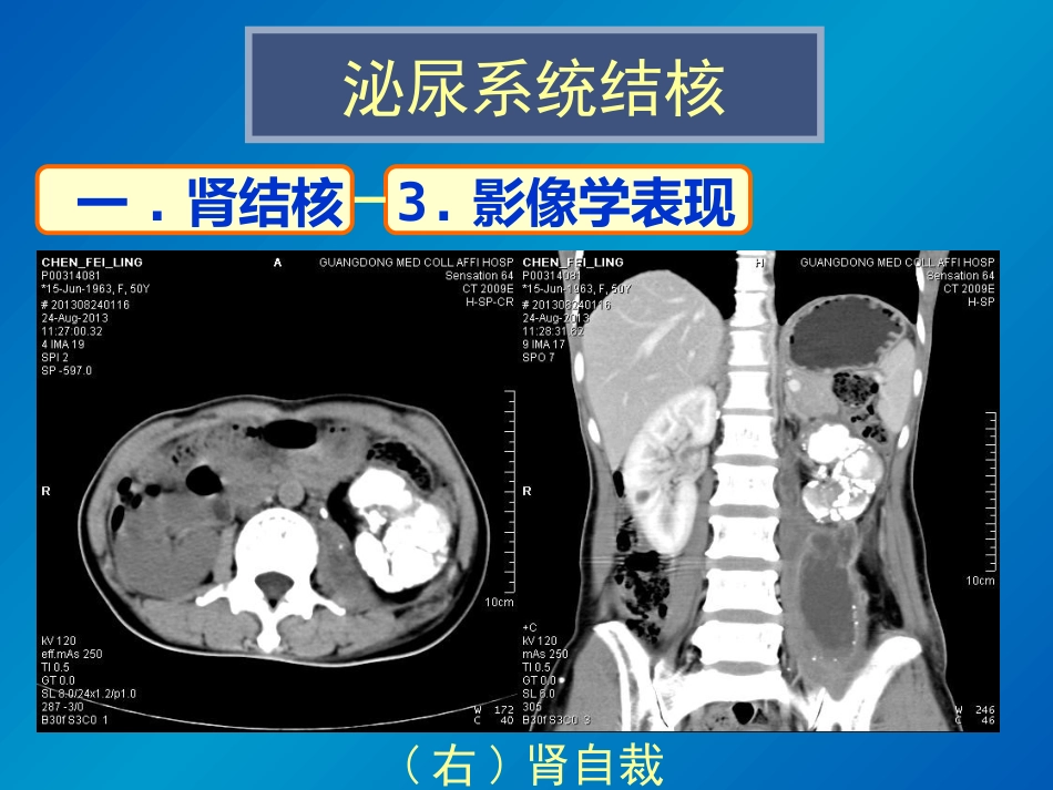 泌尿系统感染影像诊断_第15页