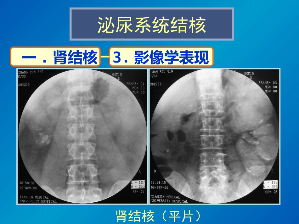 泌尿系统感染影像诊断_第6页