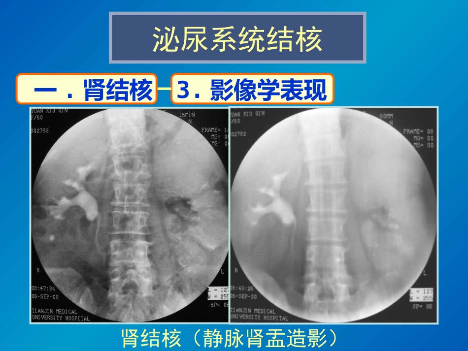 泌尿系统感染影像诊断_第7页