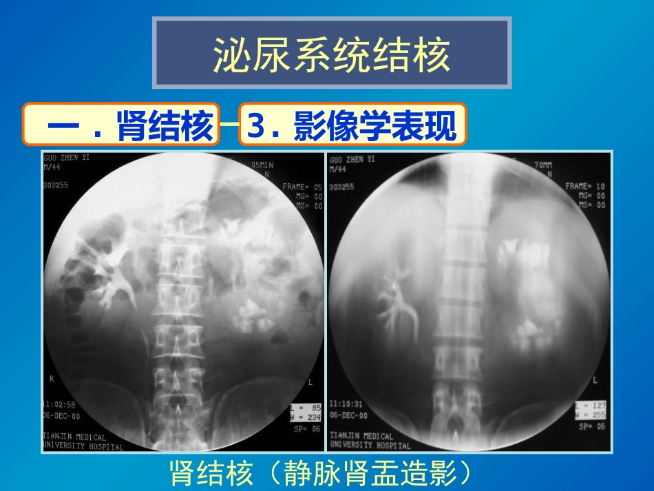泌尿系统感染影像诊断_第8页