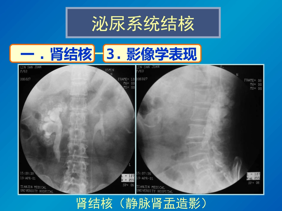 泌尿系统感染影像诊断_第9页