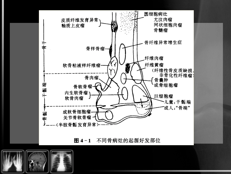 骨肿瘤影像诊断_第12页
