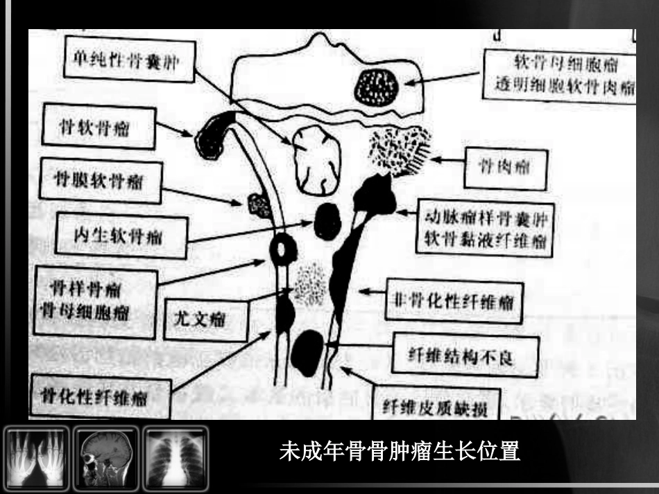 骨肿瘤影像诊断_第13页