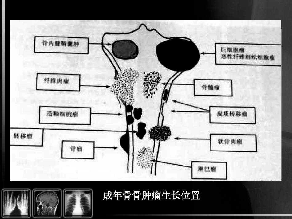骨肿瘤影像诊断_第14页