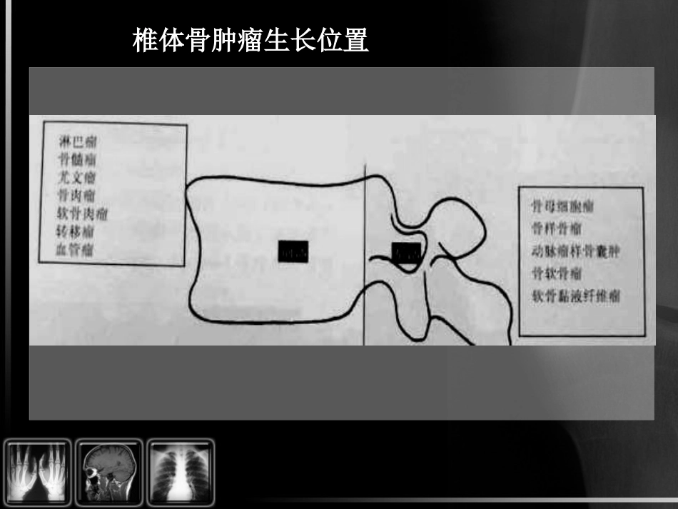 骨肿瘤影像诊断_第15页