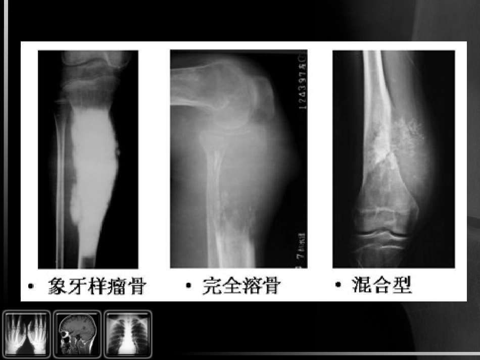 骨肿瘤影像诊断_第8页