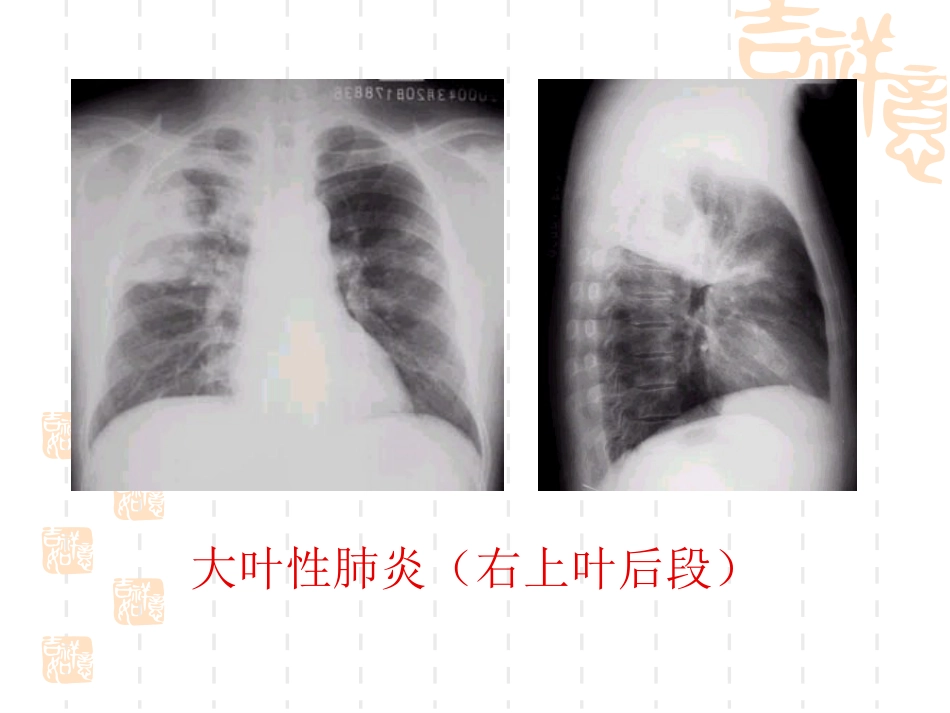 肺部常见疾病的影像诊断_第12页
