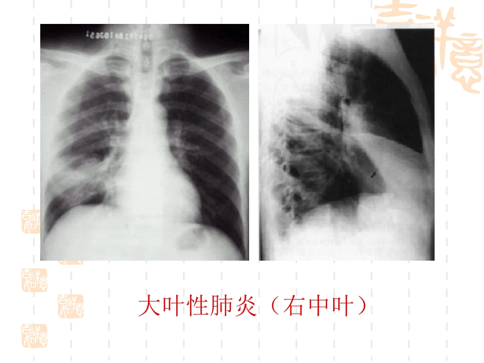 肺部常见疾病的影像诊断_第13页