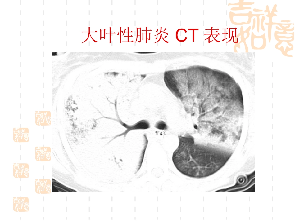 肺部常见疾病的影像诊断_第15页