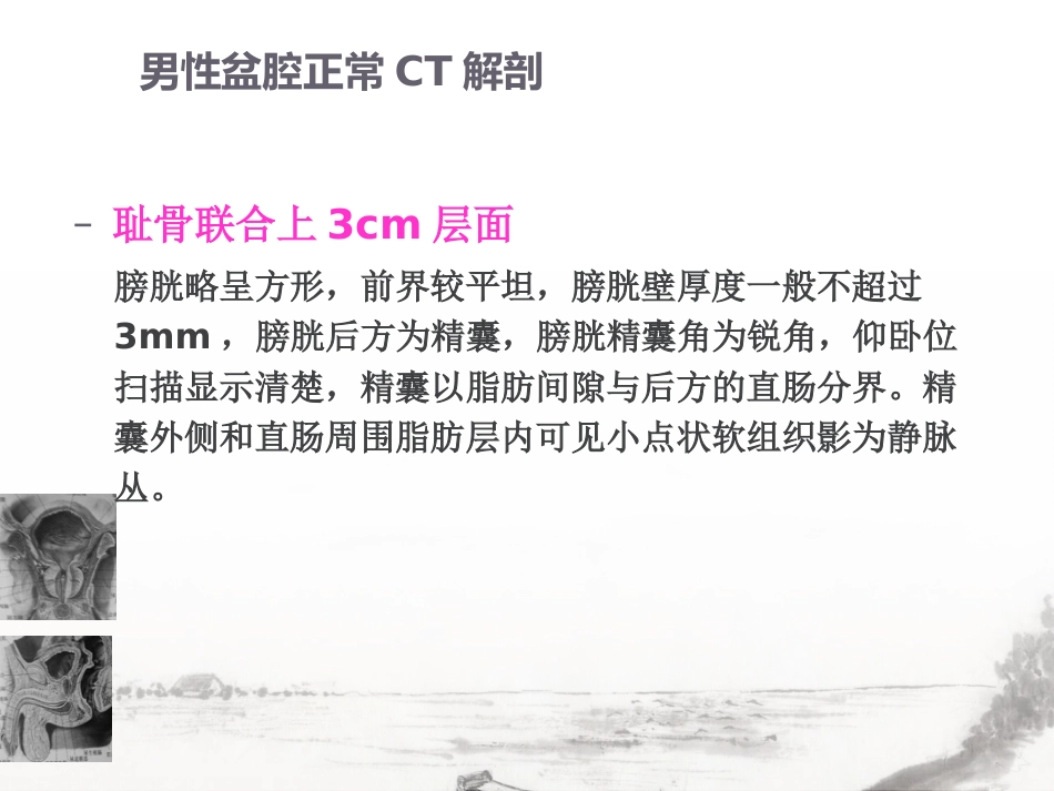 男性生殖系统疾病影像诊断_第10页