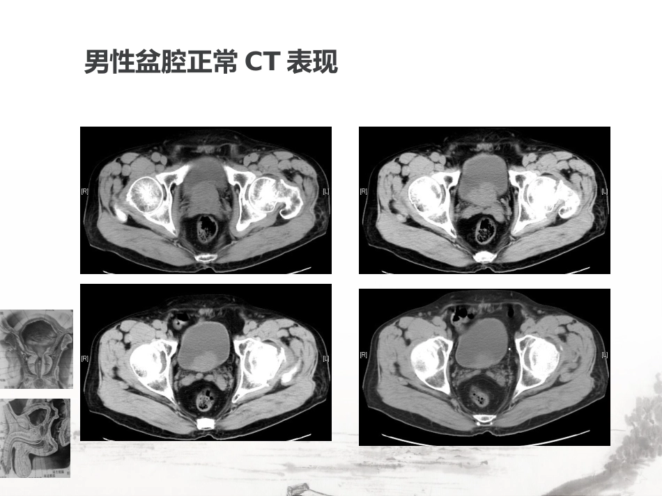 男性生殖系统疾病影像诊断_第12页