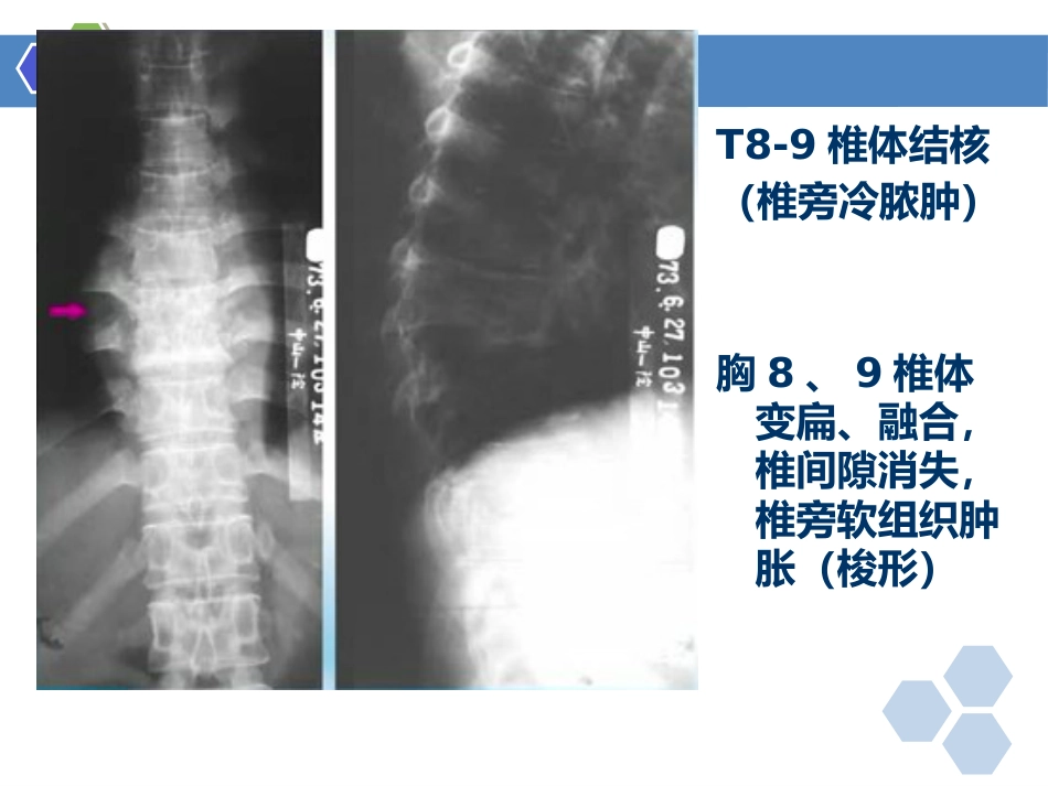 骨关节结核影像表现_第12页