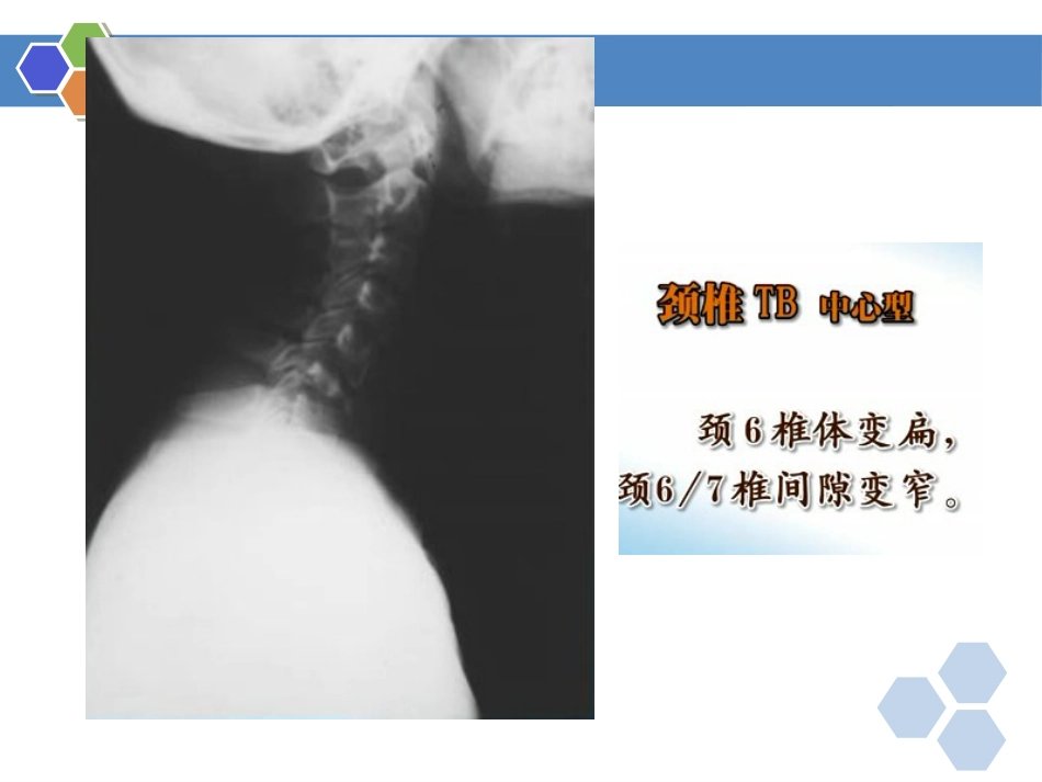 骨关节结核影像表现_第13页