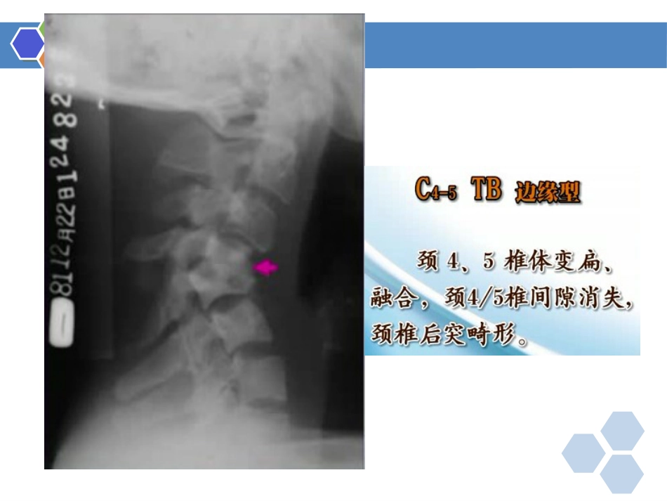 骨关节结核影像表现_第14页