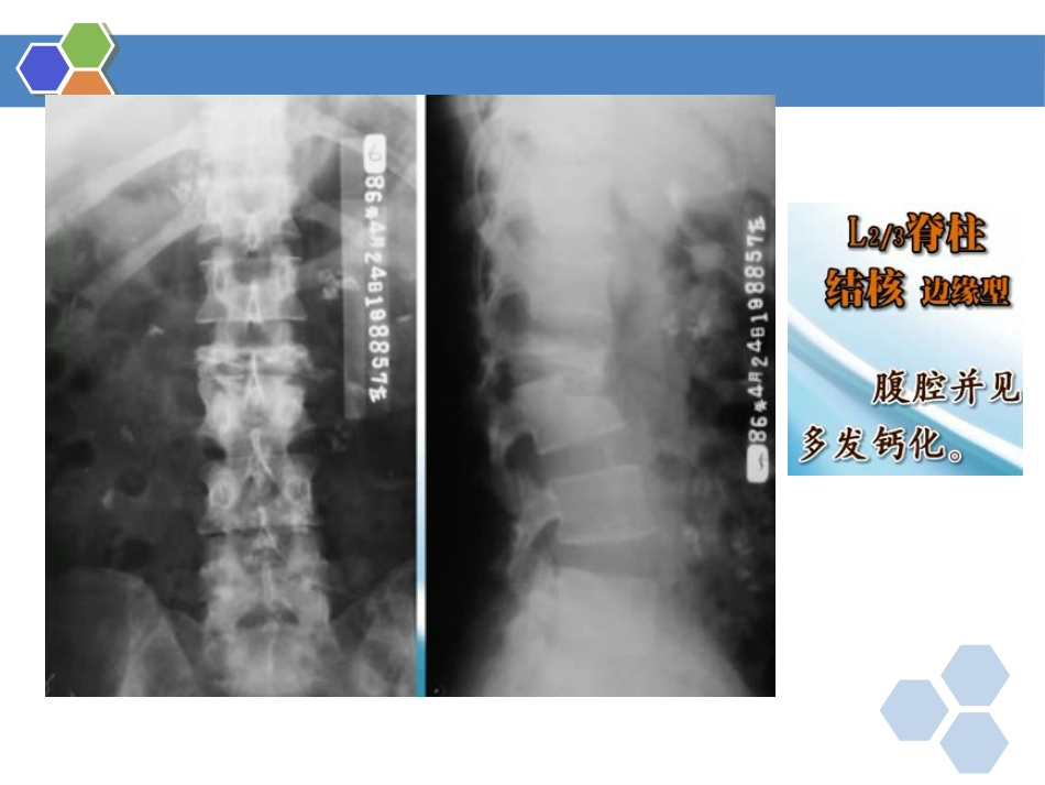 骨关节结核影像表现_第15页