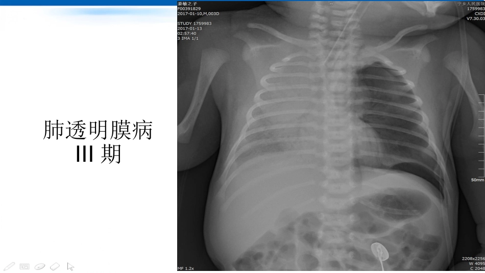 肺不张影像浅见_第13页