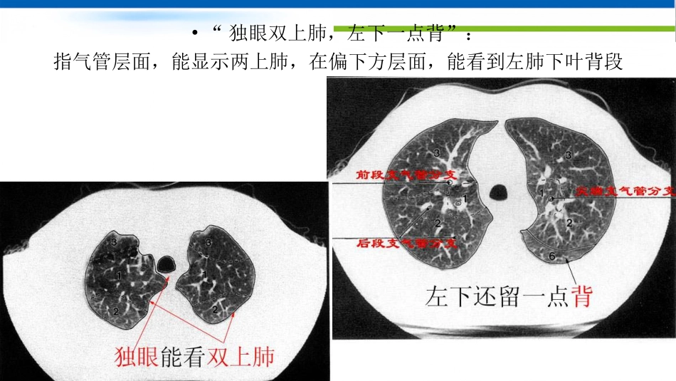 肺不张影像浅见_第4页