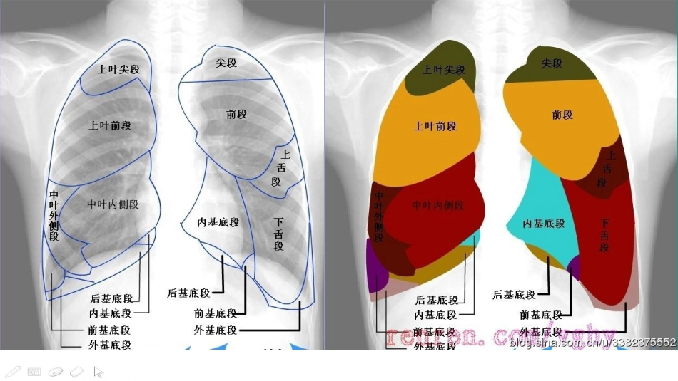 肺不张影像浅见_第8页