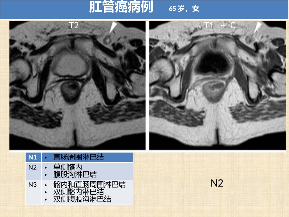 肛管和肛周疾病影像诊断 完_第10页