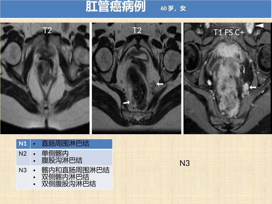 肛管和肛周疾病影像诊断 完_第11页