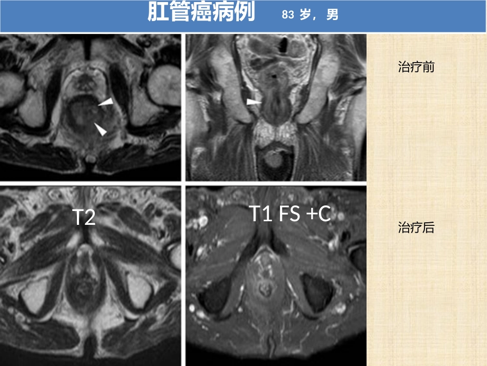 肛管和肛周疾病影像诊断 完_第13页