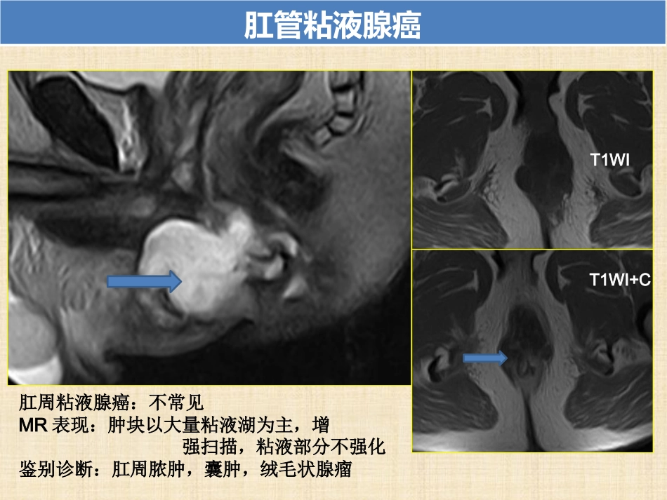 肛管和肛周疾病影像诊断 完_第14页