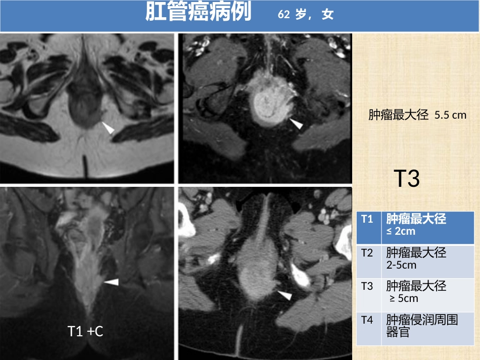 肛管和肛周疾病影像诊断 完_第8页