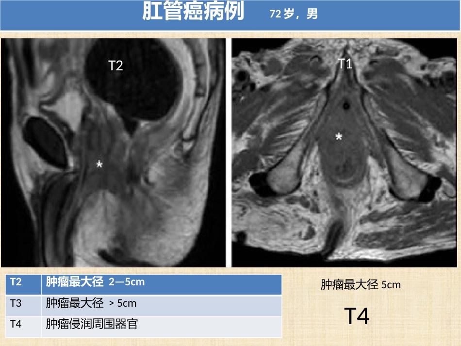肛管和肛周疾病影像诊断 完_第9页