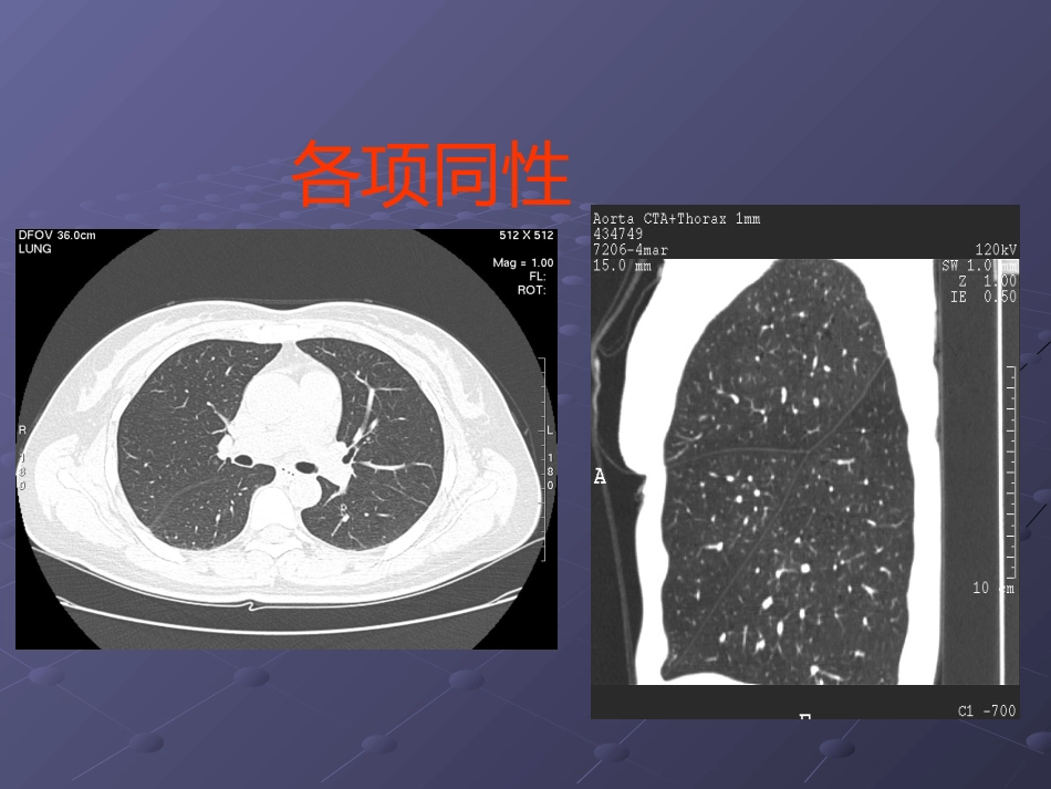 64排CT影像后处理在临床中的应用_第13页