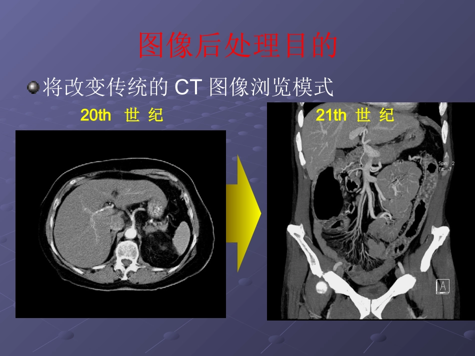 64排CT影像后处理在临床中的应用_第8页