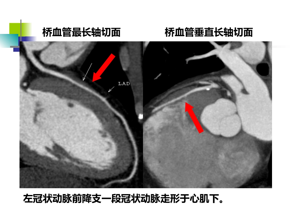 64排CT 对冠状动脉心肌桥的影像学评价_第15页