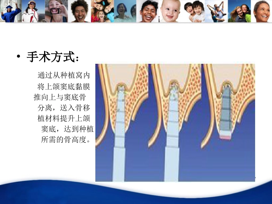 上颌窦内提升手术_第4页