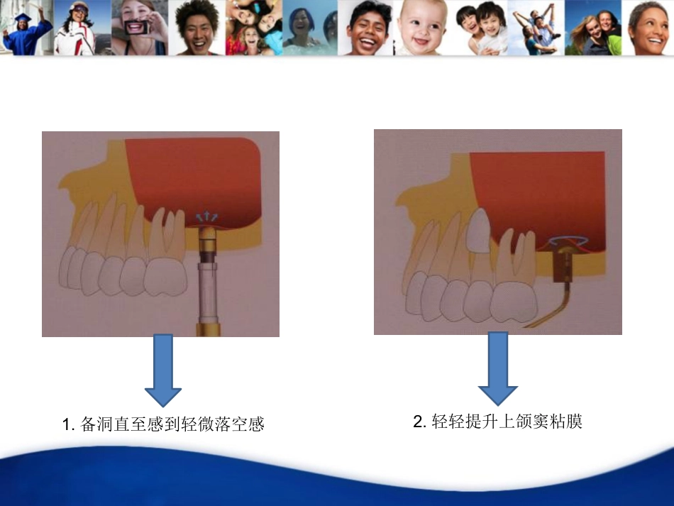 上颌窦内提升手术_第9页