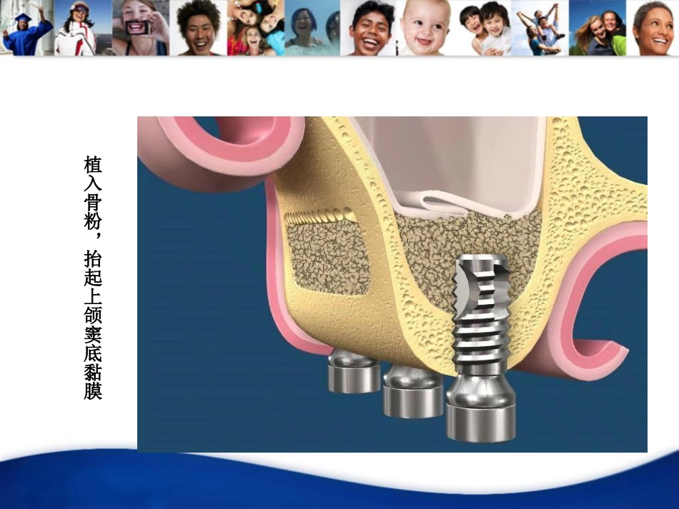 上颌窦外提升手术_第10页