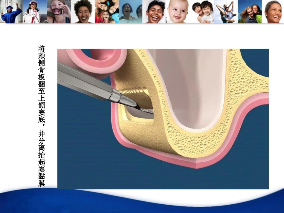 上颌窦外提升手术_第7页