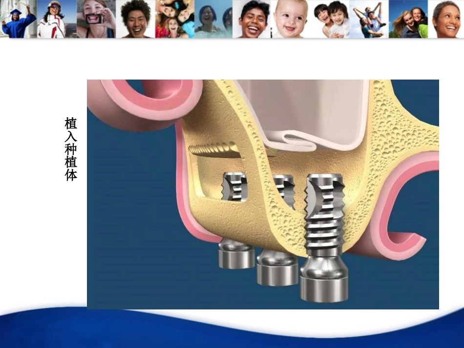 上颌窦外提升手术_第8页
