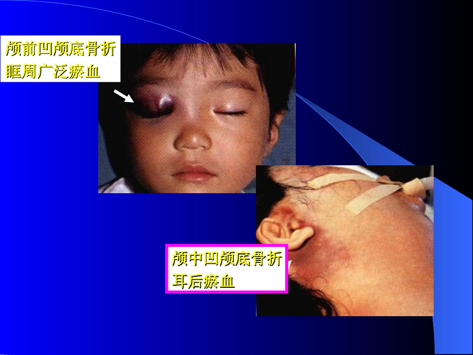 脑外科-颅脑损伤_第13页