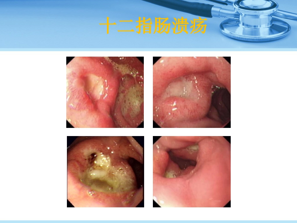 消化性溃疡_第10页