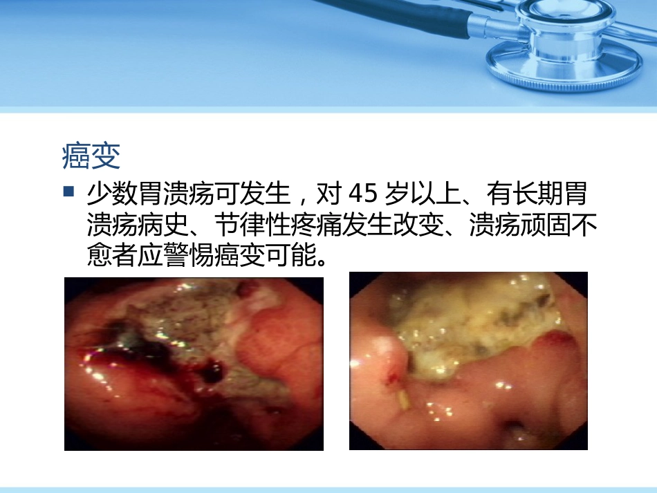 消化性溃疡_第13页