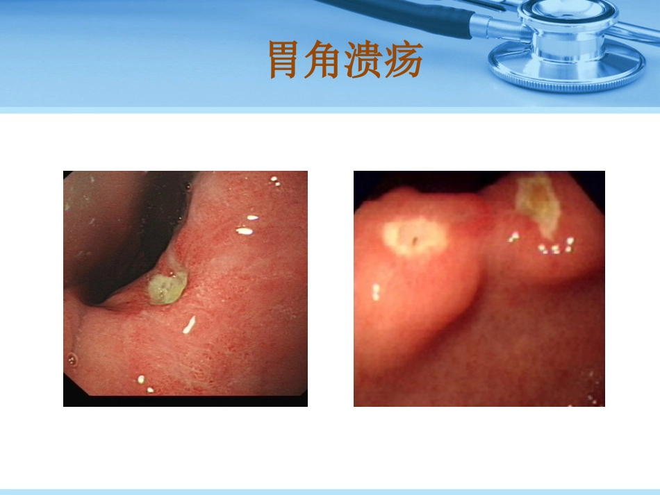 消化性溃疡_第9页