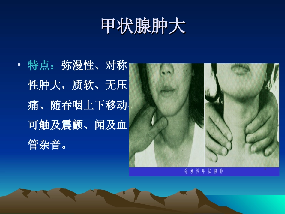 内分泌科-甲亢_第13页