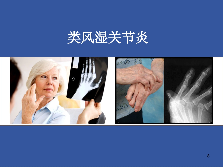 风湿免疫科-风湿病是在怎么引起的_第8页