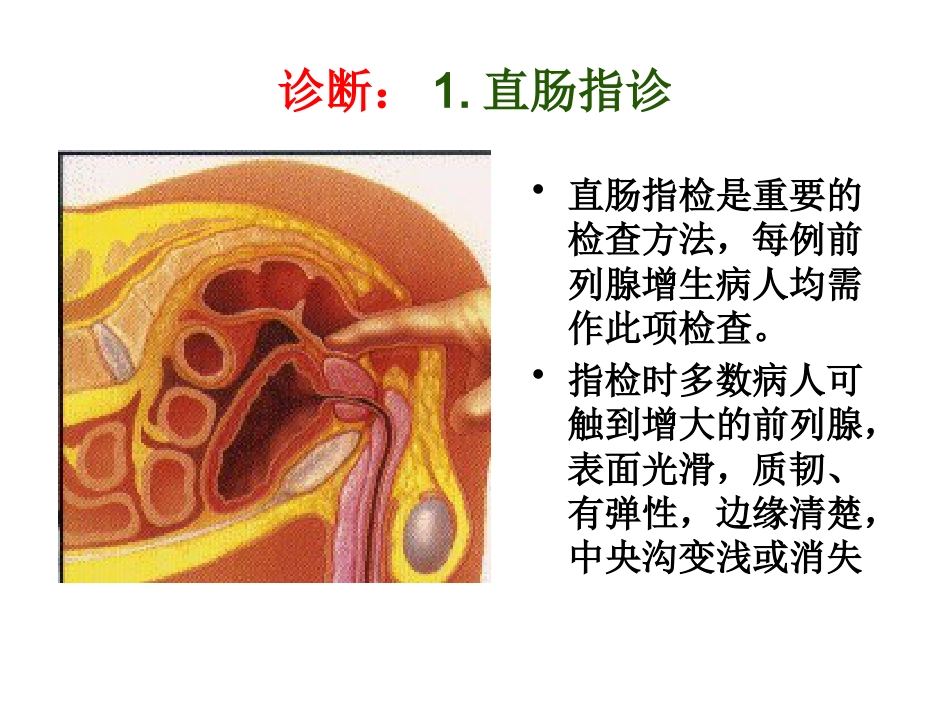前列腺增生_第13页