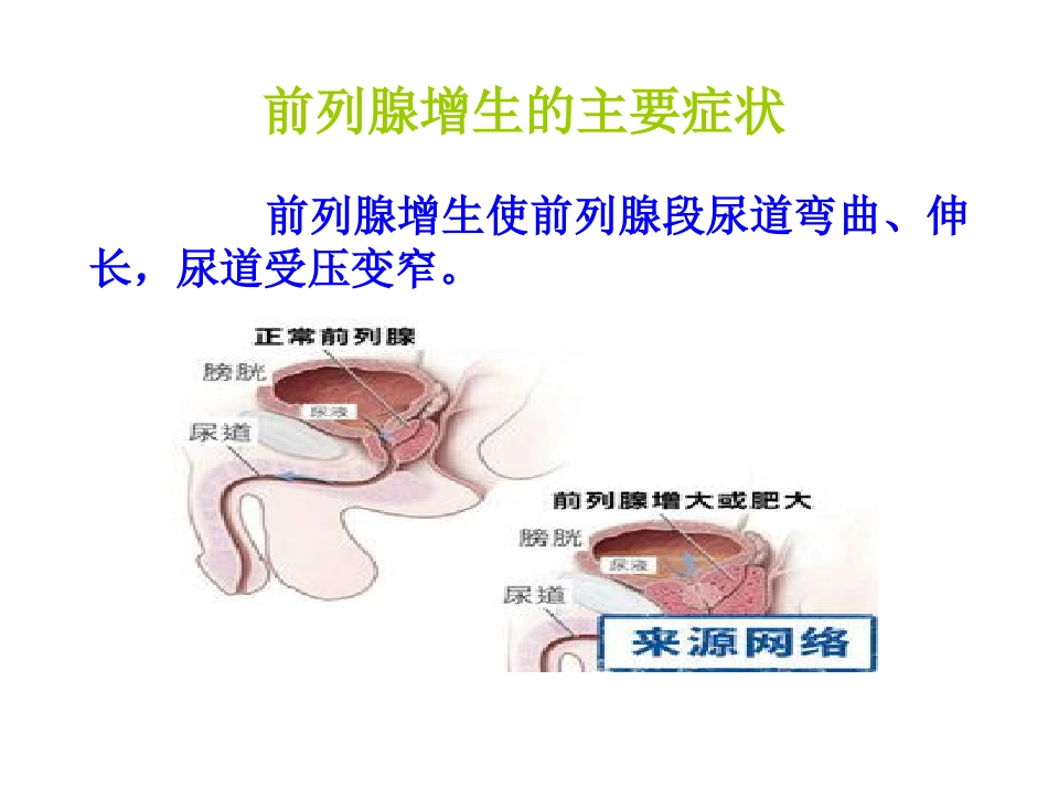 前列腺增生_第3页