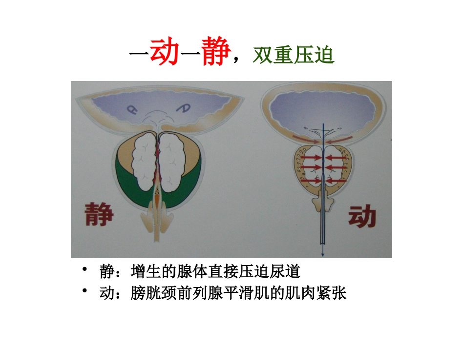 前列腺增生_第6页