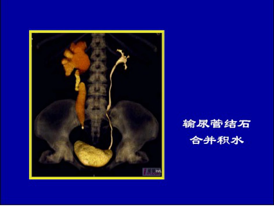 泌尿科-泌尿系结石病人的护理_第12页