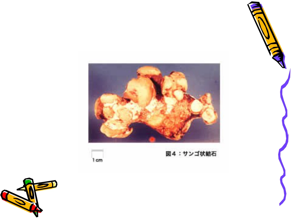 泌尿科-泌尿系结石病人的护理_第5页