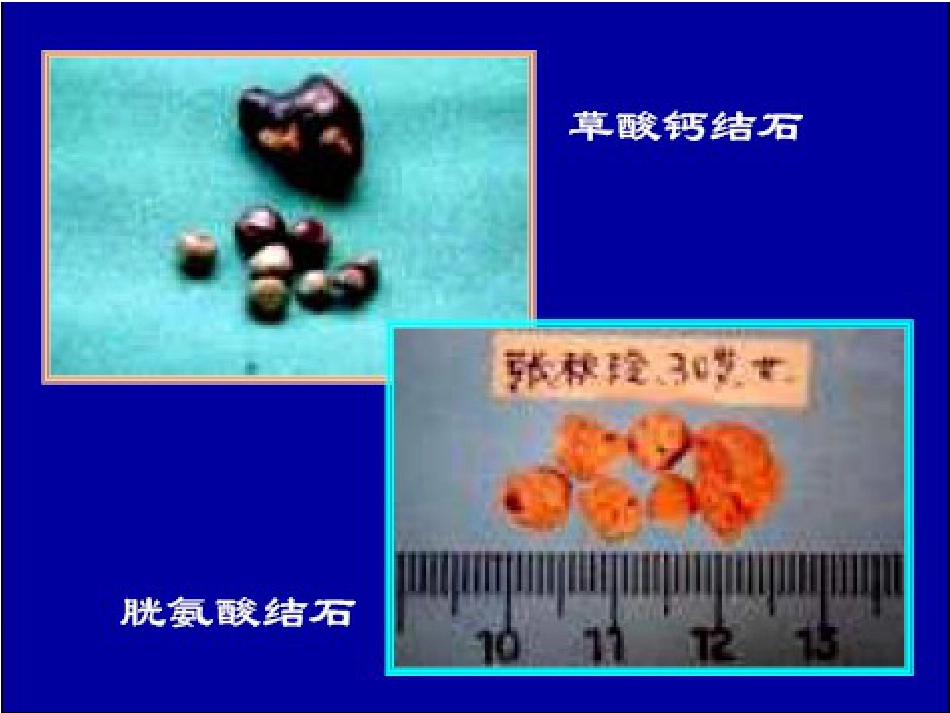 泌尿科-泌尿系结石病人的护理_第8页