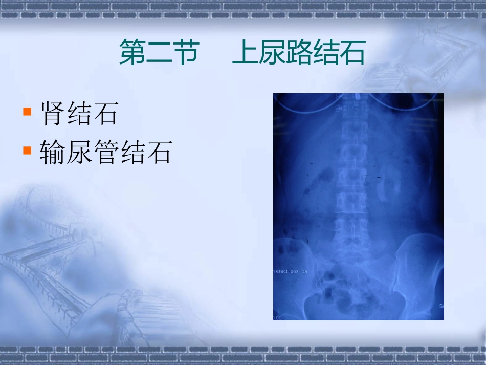 泌尿科-尿石症_第12页